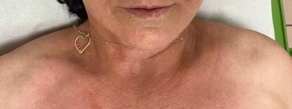 După: Gât și decolteu — iCOONE Laser Med.