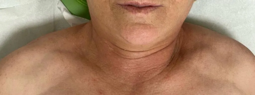 Înainte: Gât și decolteu — iCOONE Laser Med.