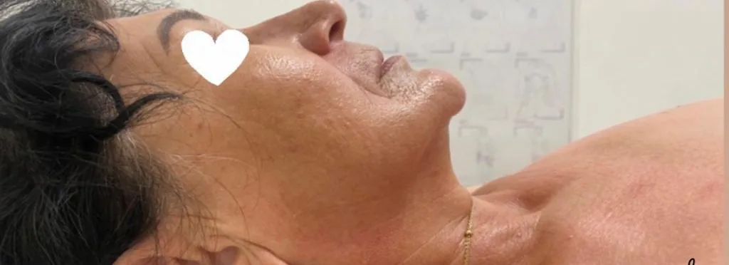 După: Mandibulă și gât — iCOONE Laser Med.