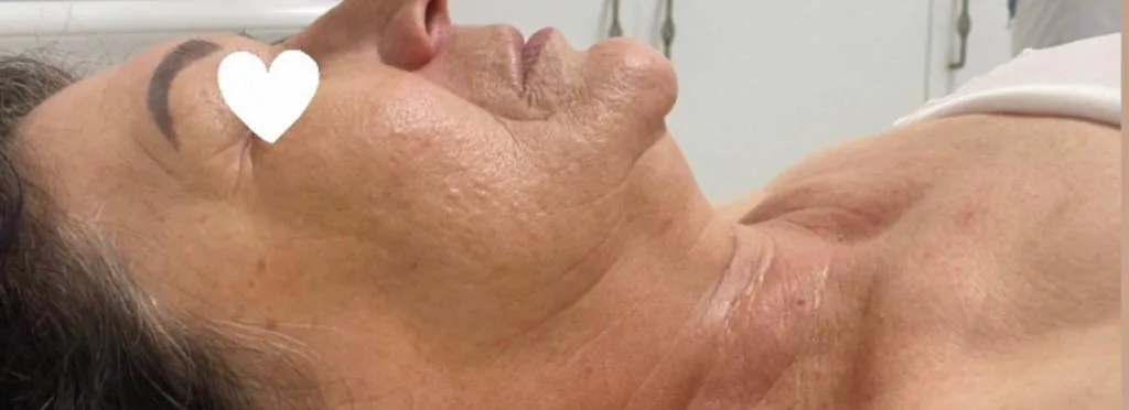 Înainte: Mandibulă și gât — iCOONE Laser Med.